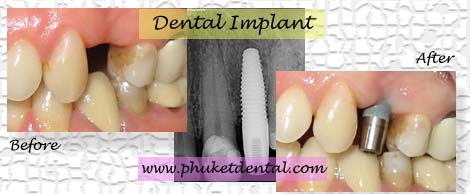 Dental Implant at Phuket dental clinic